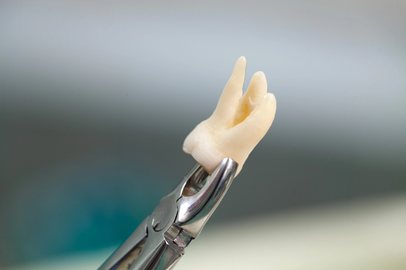 wisdom teeth removal
