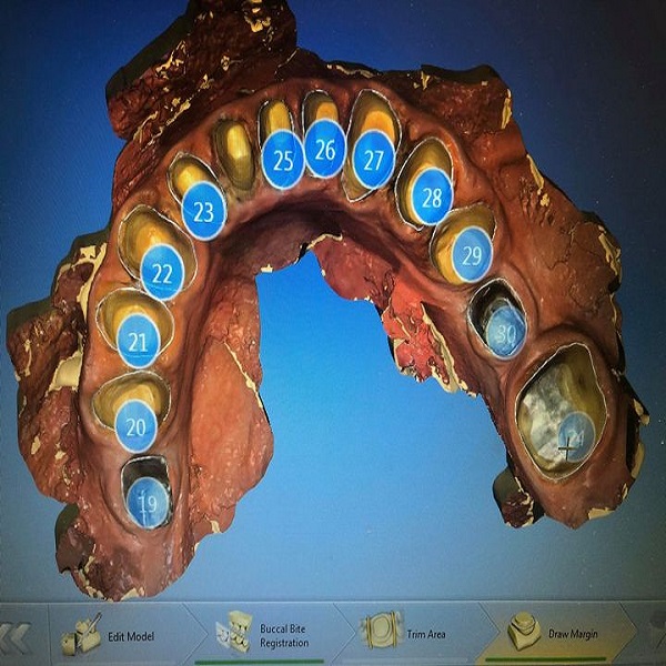 Michael L Bleeker, DMD – Full Mouth Dental Implants Scottsdale AZ