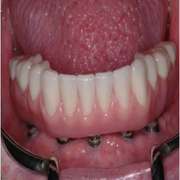 Michael L Bleeker, DMD – Full Mouth Teeth Implants in Scottsdale AZ