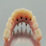 all on 4 dental implants scottsdale az