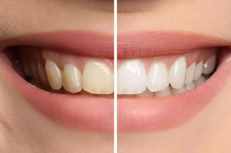 gallery whitening 1