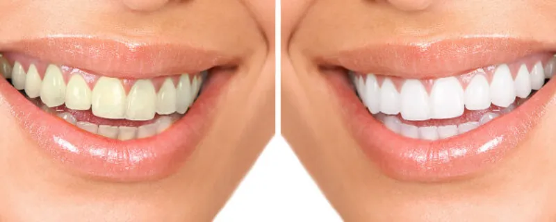 gallery whitening 2