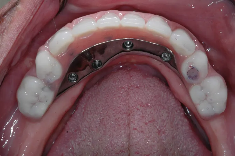 implant dentures 1