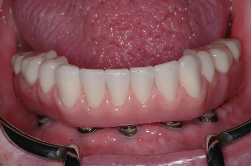 implant dentures 2