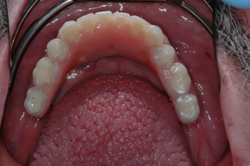 implant dentures 3