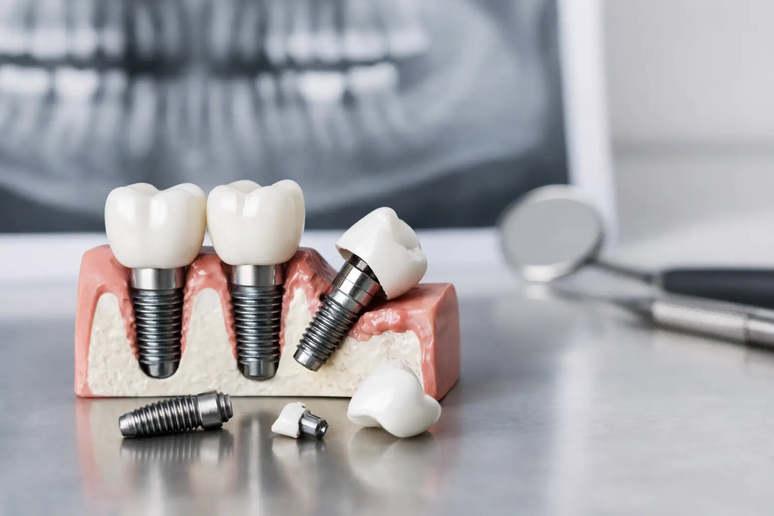 Can Dental Implants Fail? What to Know