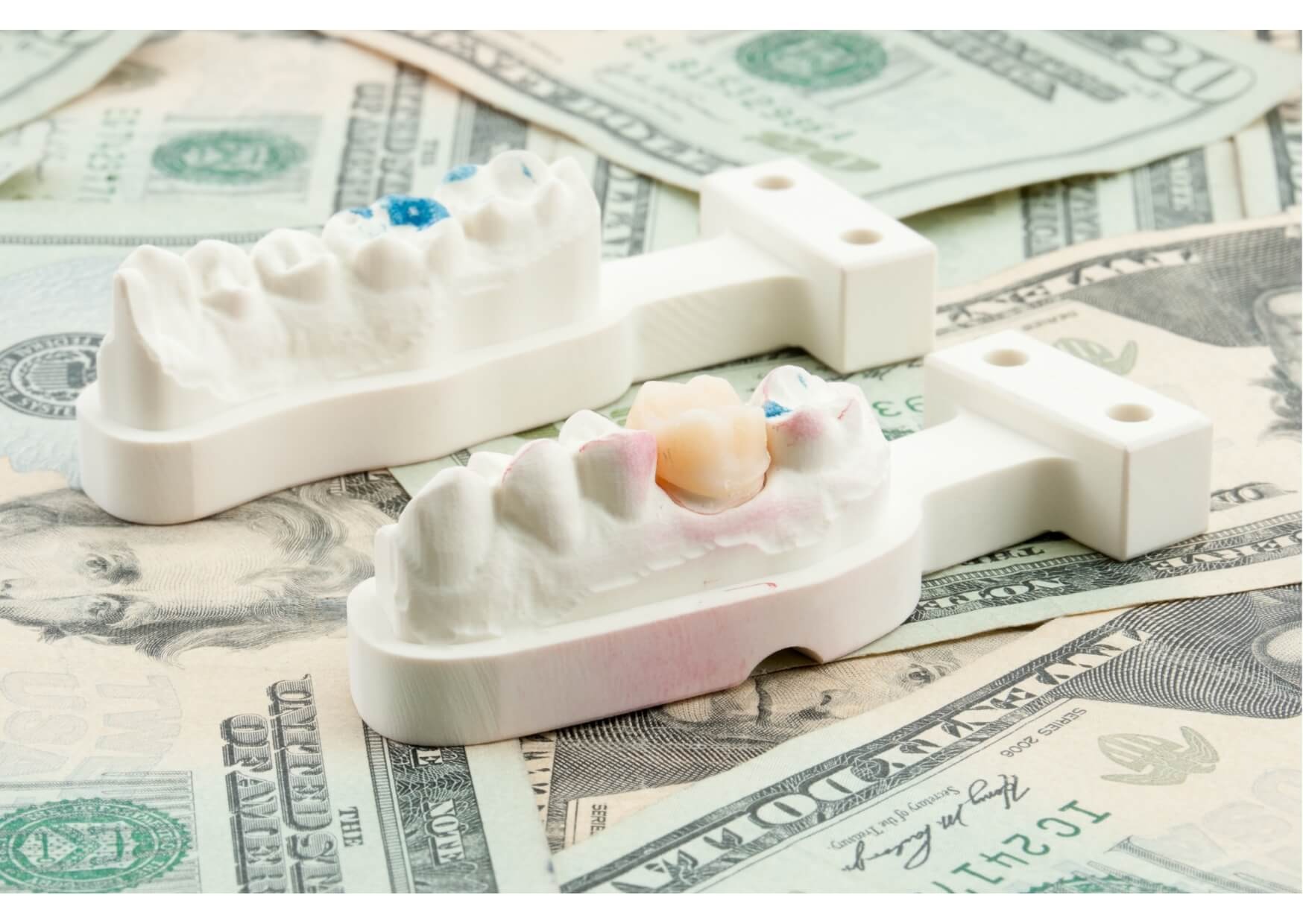 Dental implant models displayed on U.S. currency to represent the cost of dental implants and restorative dental care