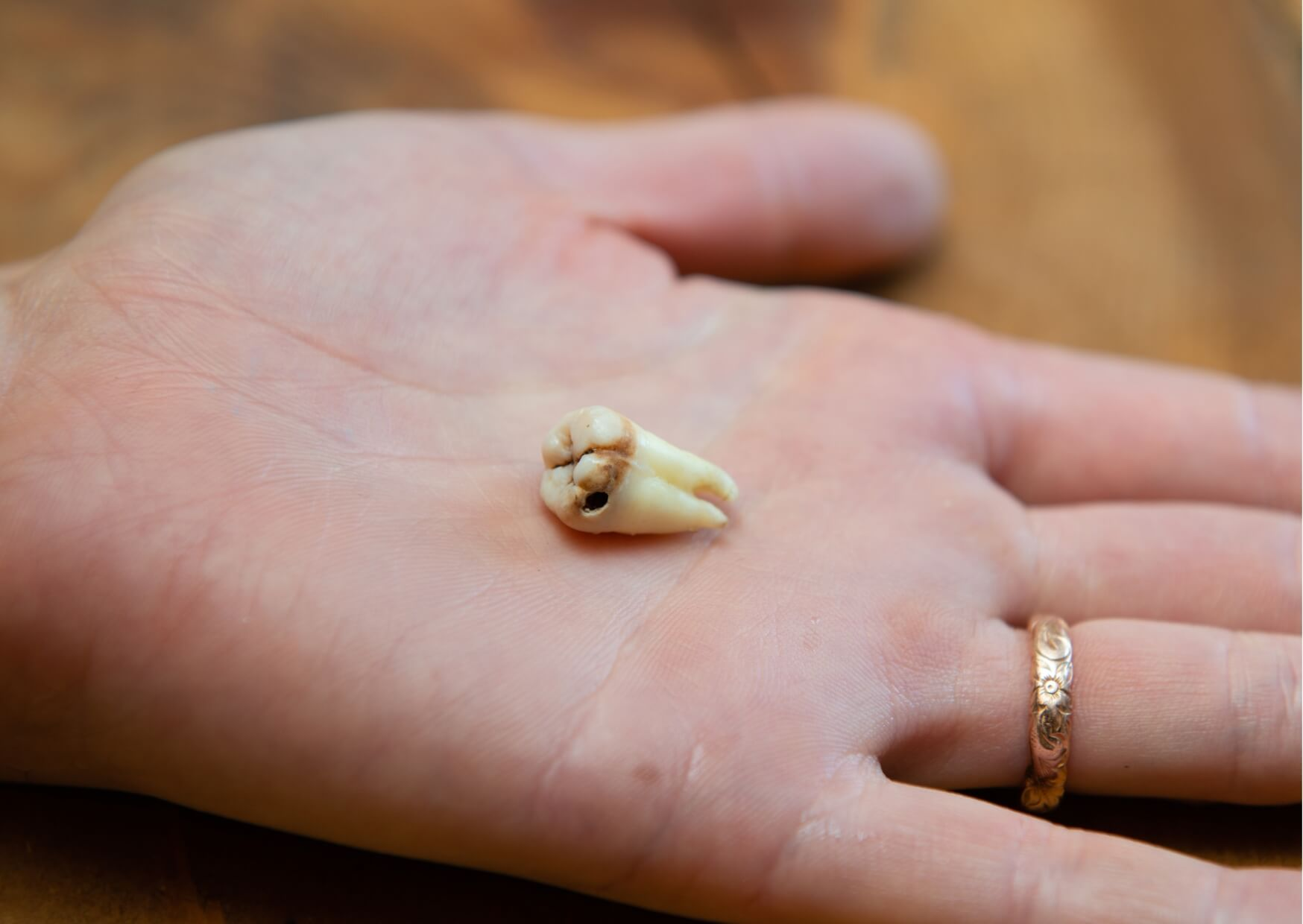Extracted tooth with visible decay resting in a person's hand, illustrating that permanent teeth do not grow back after removal and may require replacement options.
