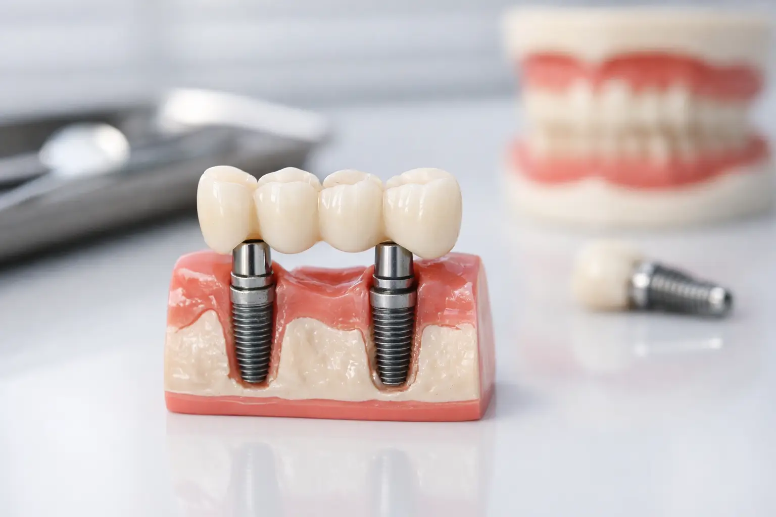 Implant Supported Bridge Guide for Patients