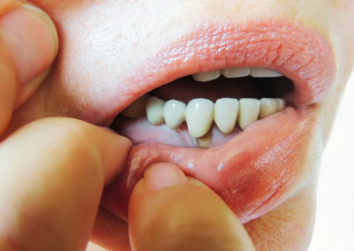 Close-up of gums and teeth showing changes that may help illustrate gingivitis vs. periodontitis.