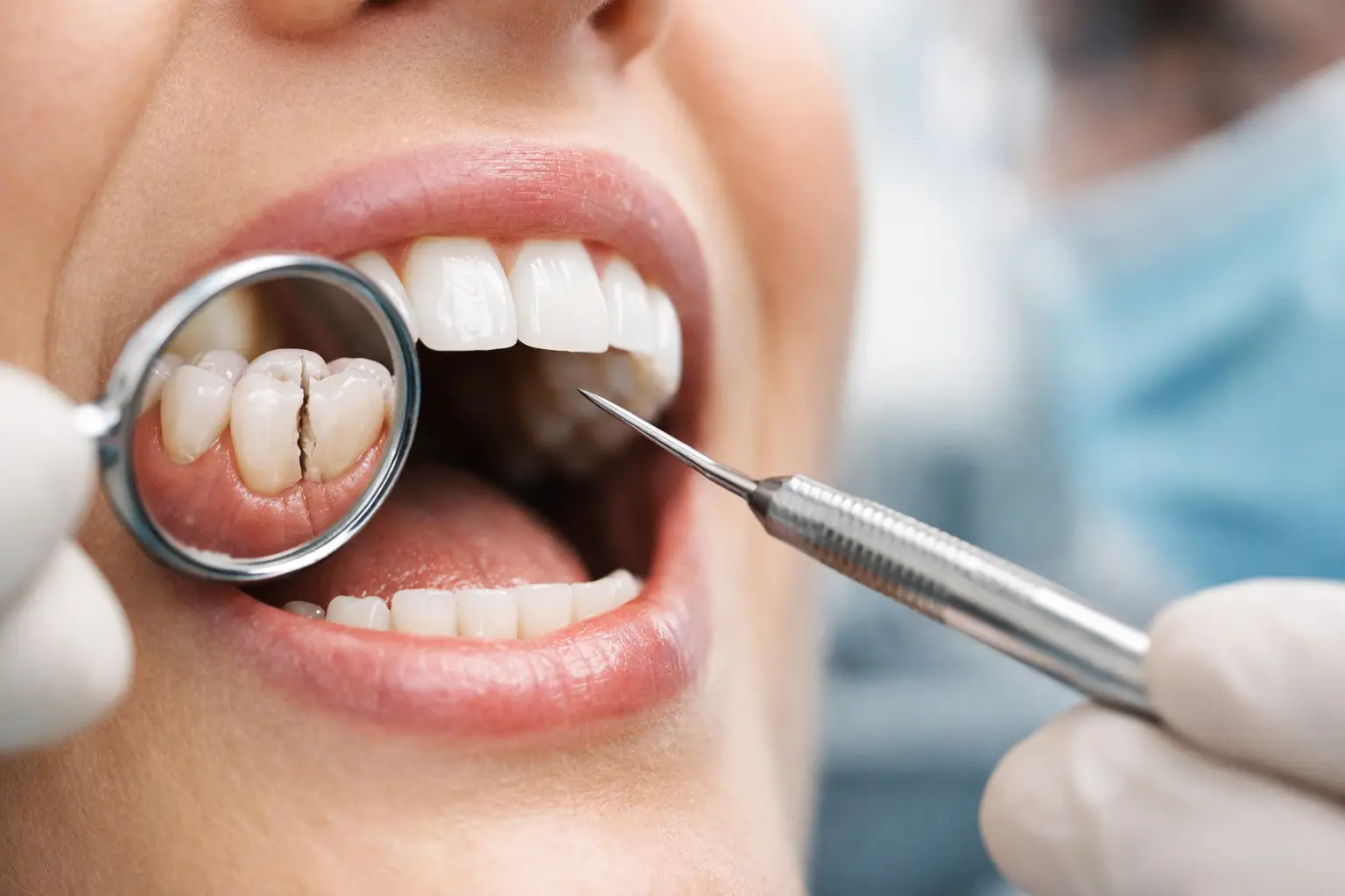 How to Treat a Cracked Tooth: What Comes Next