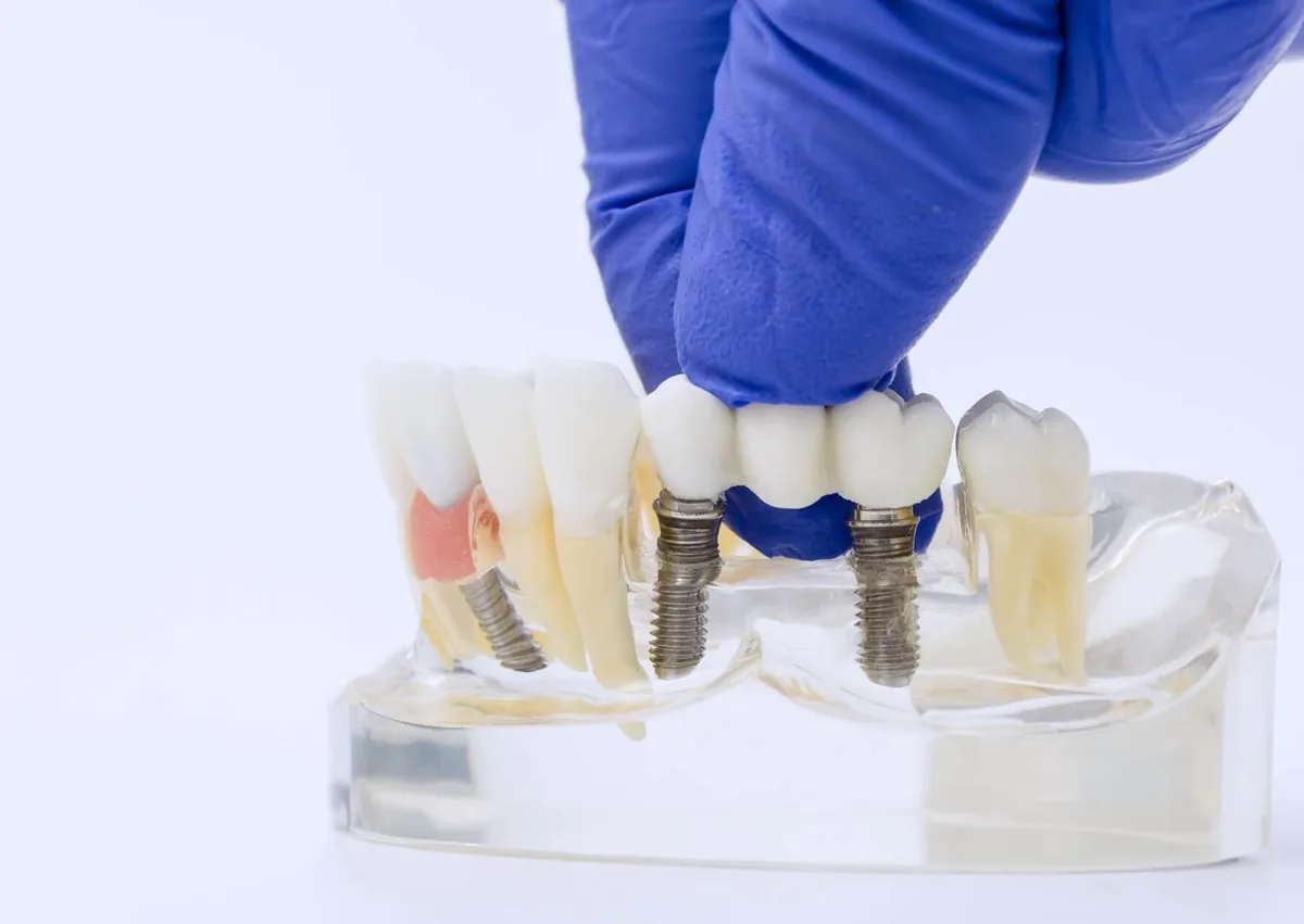 Dental model showing an implant-supported bridge attached to dental implants to replace multiple missing teeth.