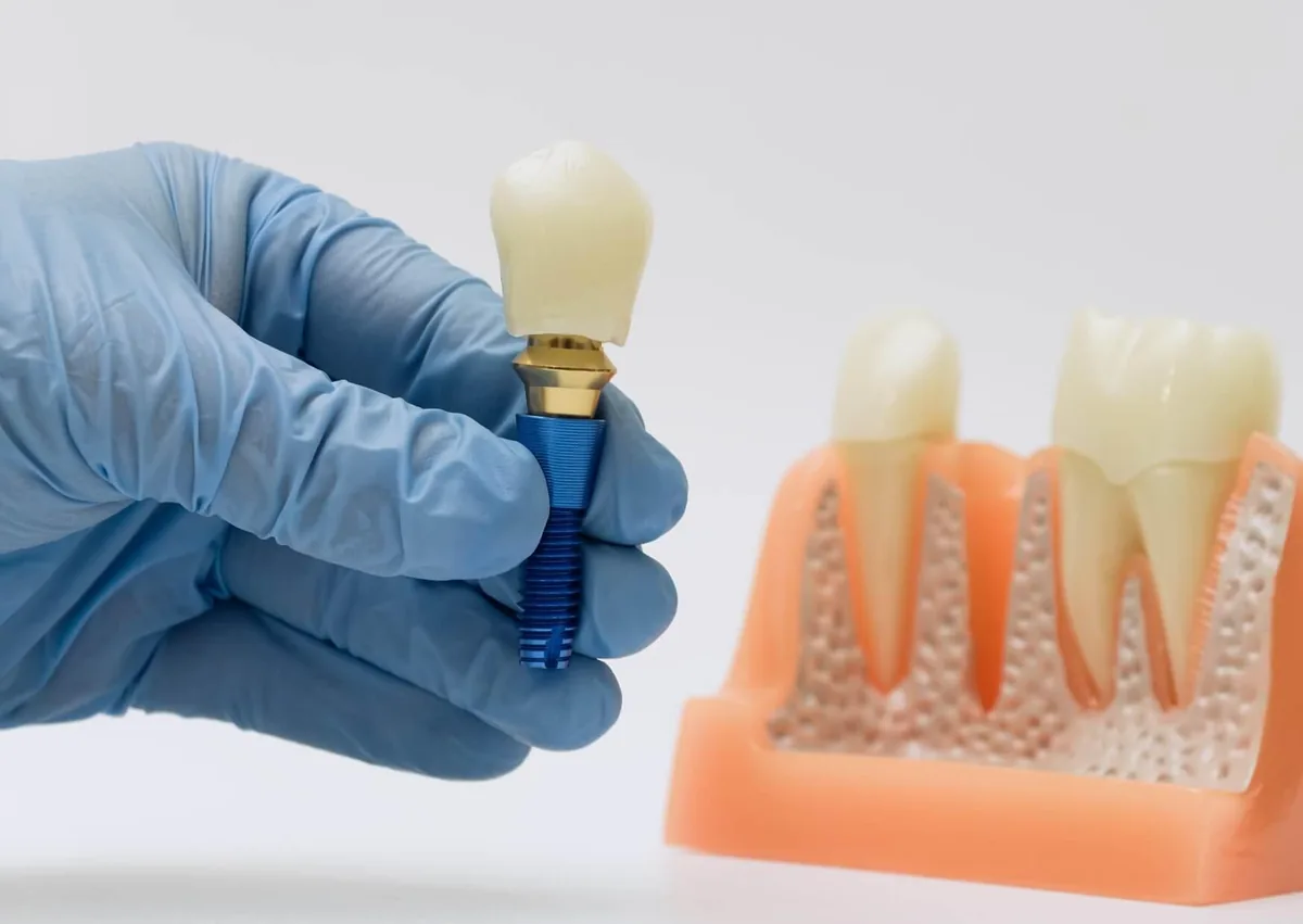 Dental professional holding a single tooth implant model while explaining factors that affect single tooth implant cost.