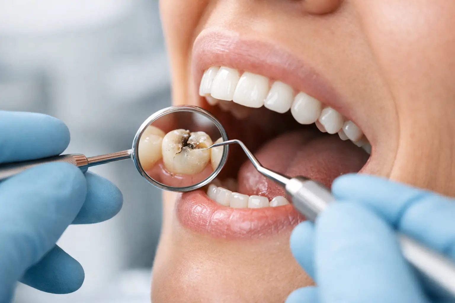 When Do Crowns Need Replacement? Key Signs